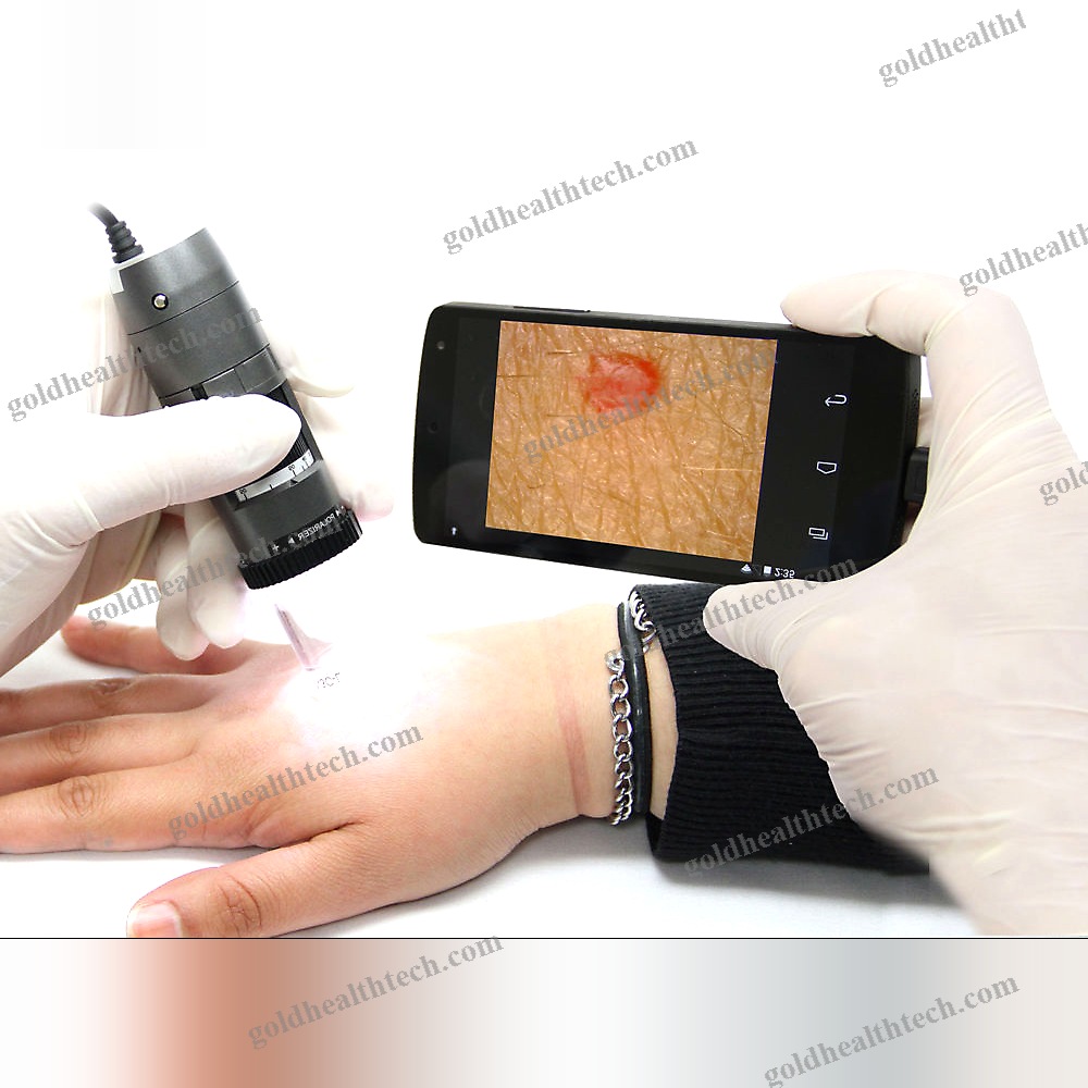 Video Dermatoscope