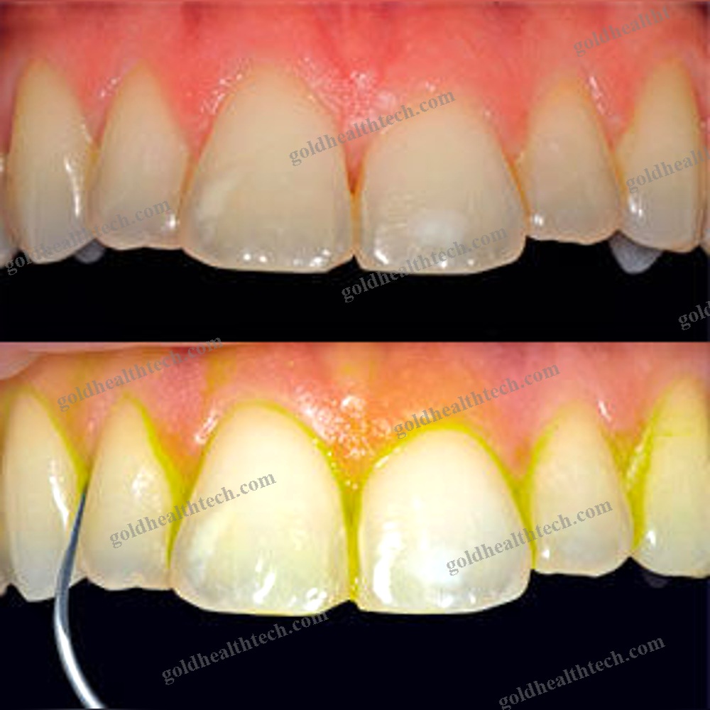 Ultrasonic Dental Scaler