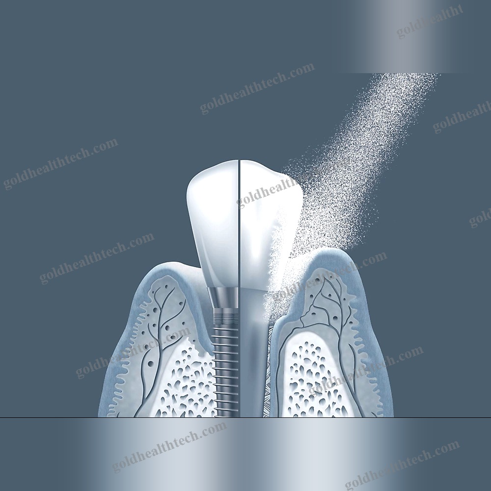 Dental Air Polisher
