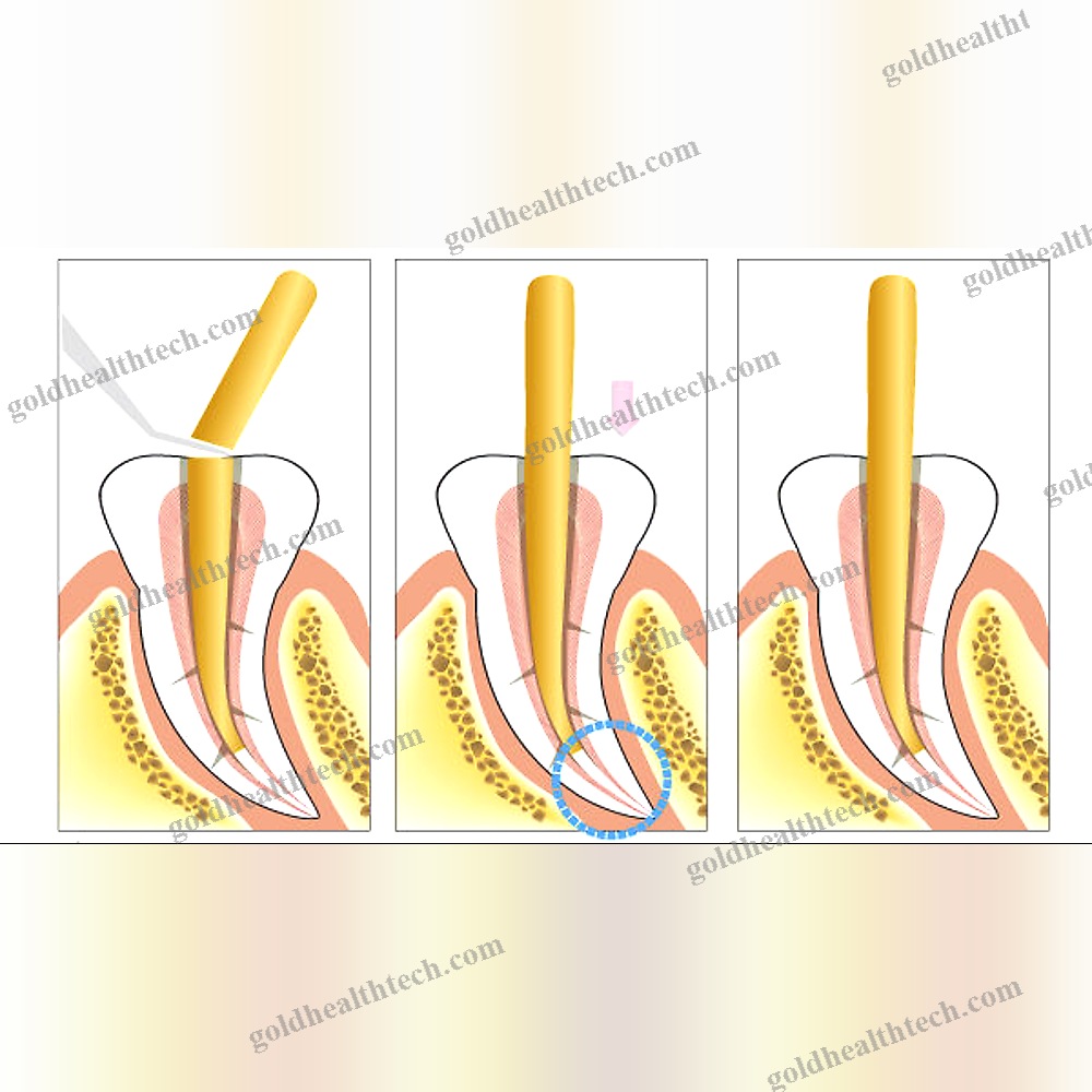 Cordless Root Canal Obturator
