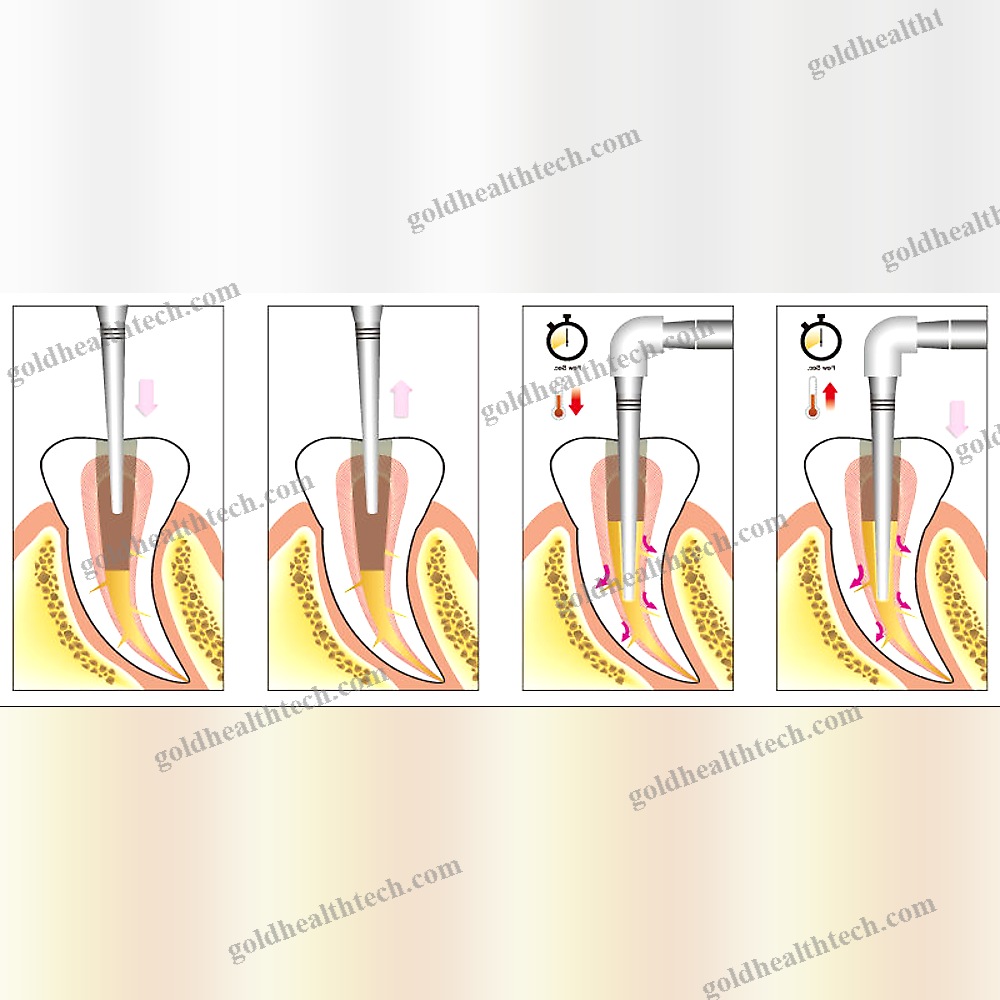 Cordless Root Canal Obturator