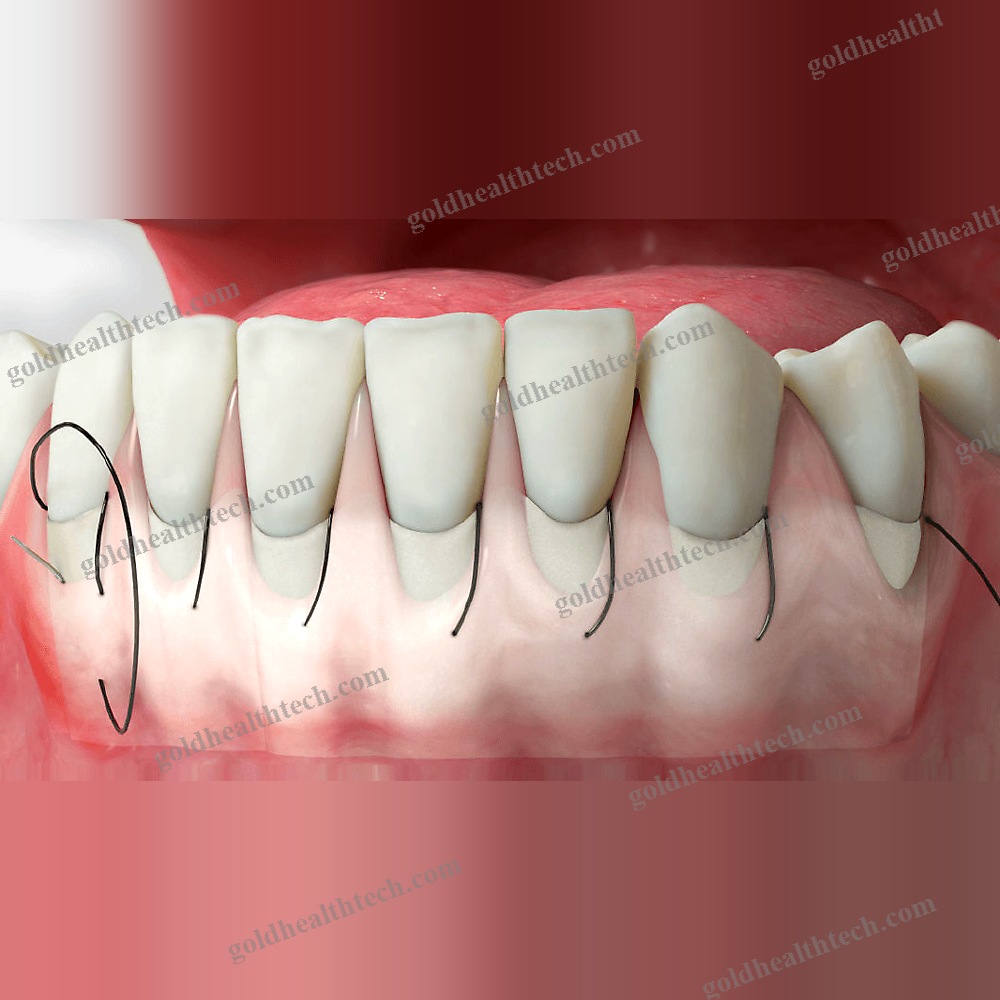 Buccal Tissue Matrix