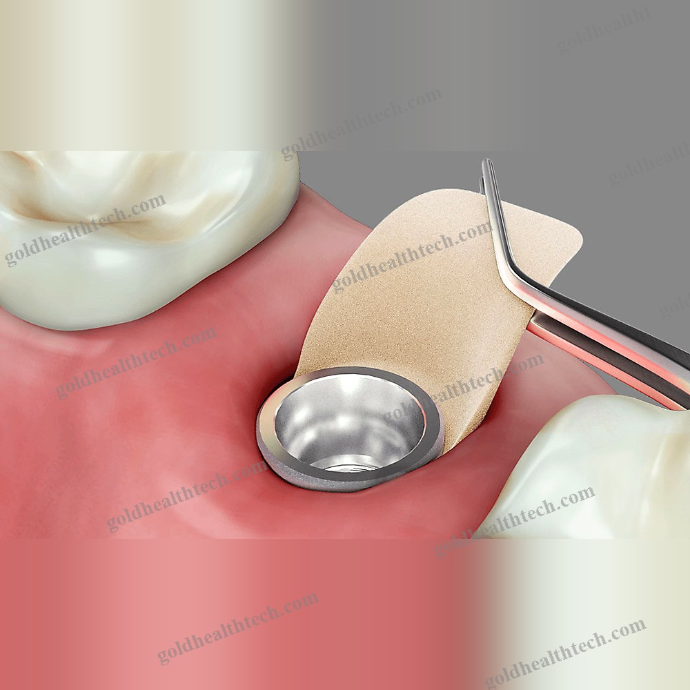 Buccal Tissue Matrix