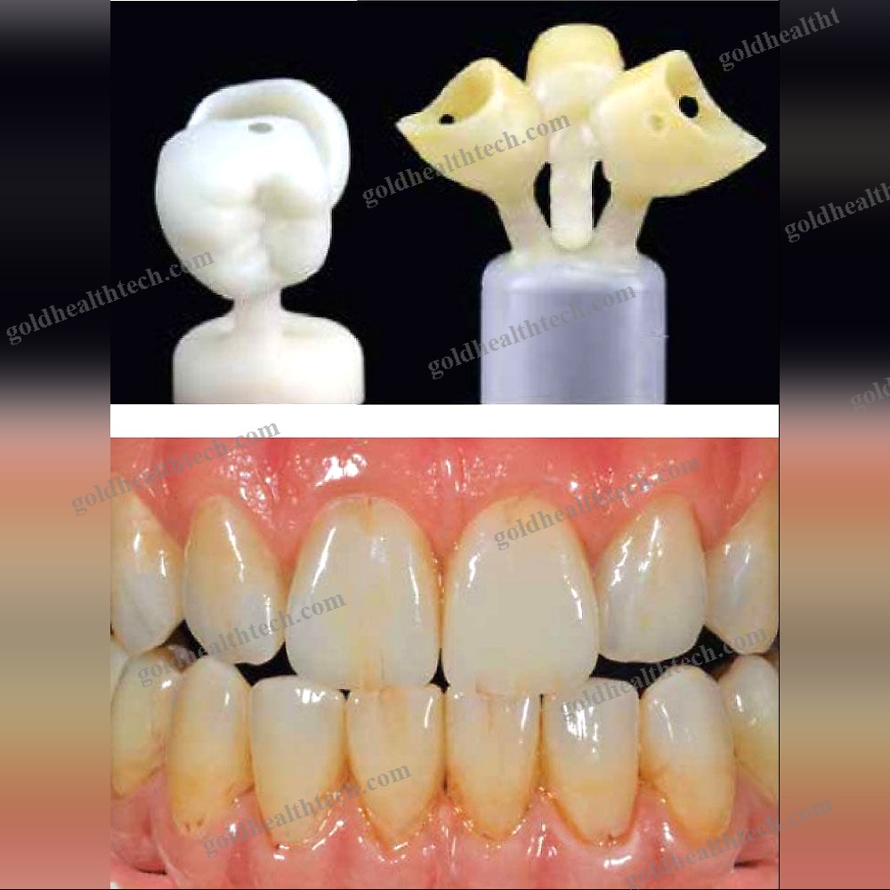Acrylic Dental Prosthesis