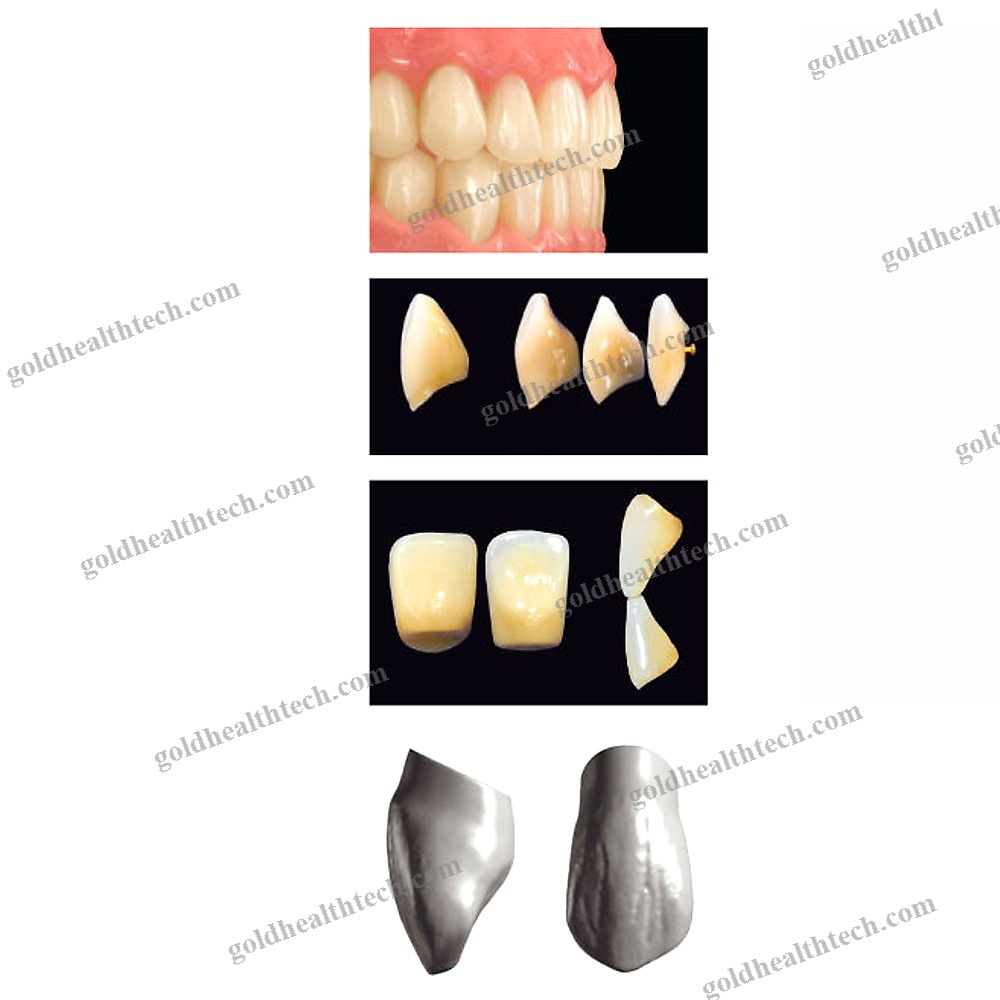Acrylic Dental Prosthesis