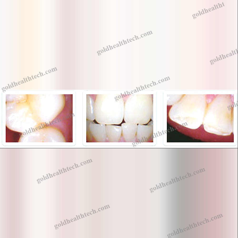 Intraoral Camera
