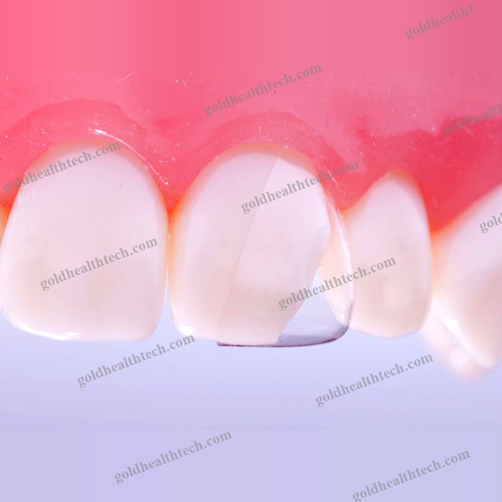 Buccal Tissue Matrix