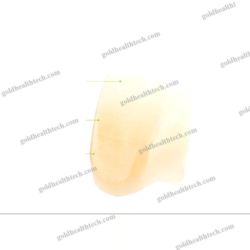 Zirconia Dental Prosthesis