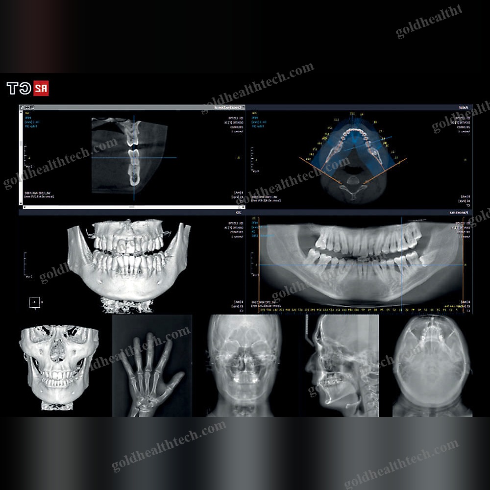 Cephalometric X-Ray System