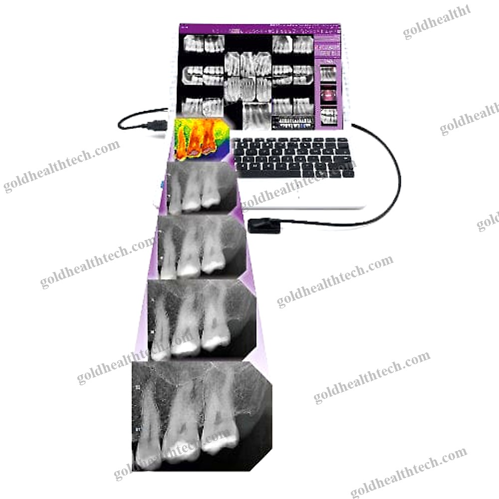 Dental Radiography Intra-Oral Detector