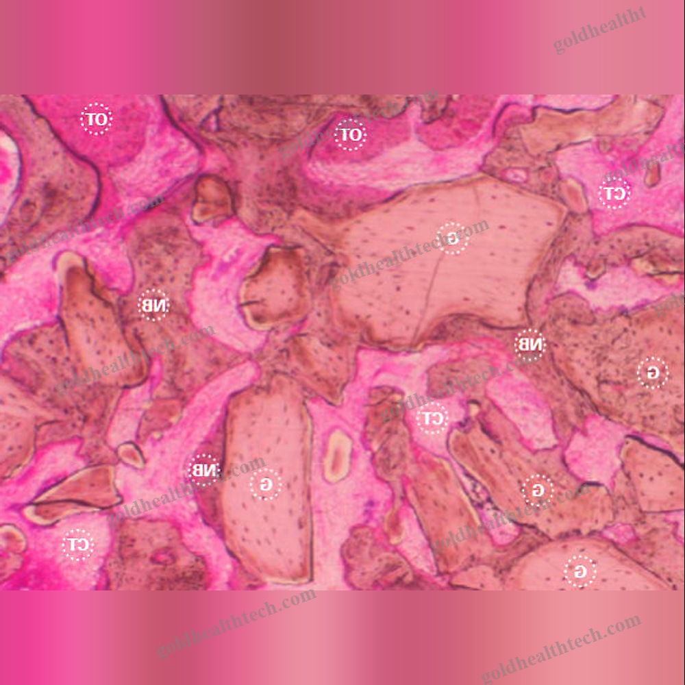 Xenograft Bone Substitute