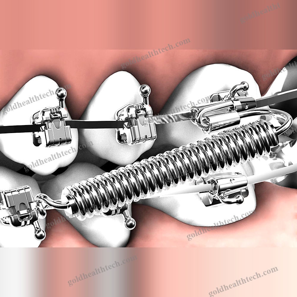 Buccal Tube