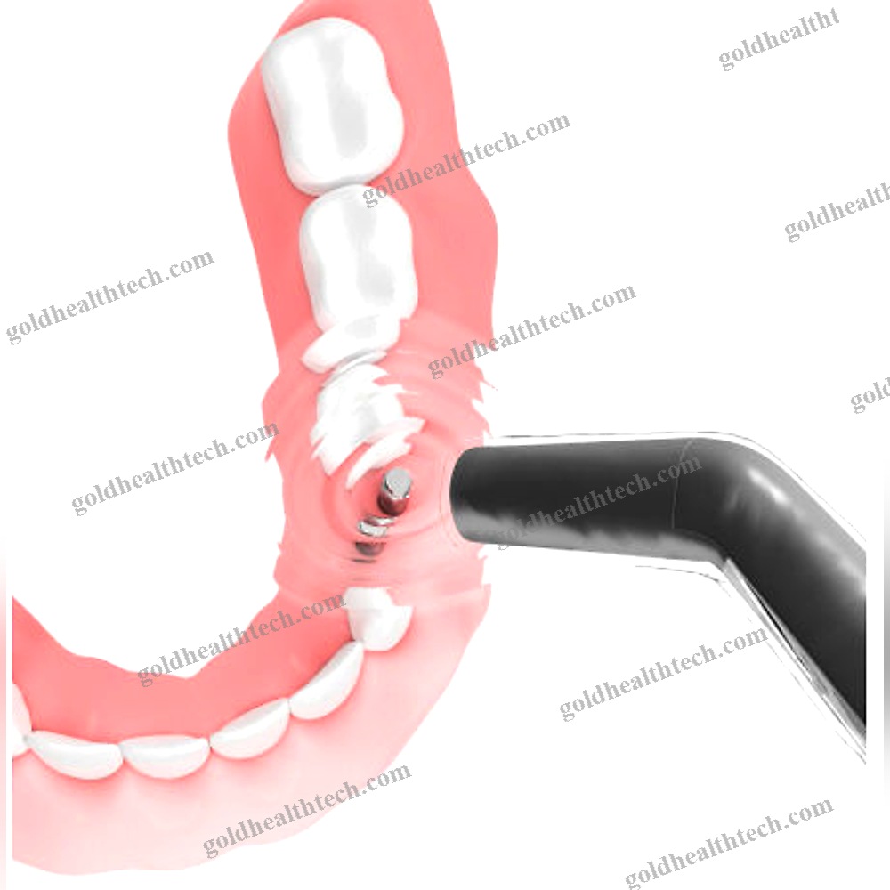 Cylindrical Implant Abutment