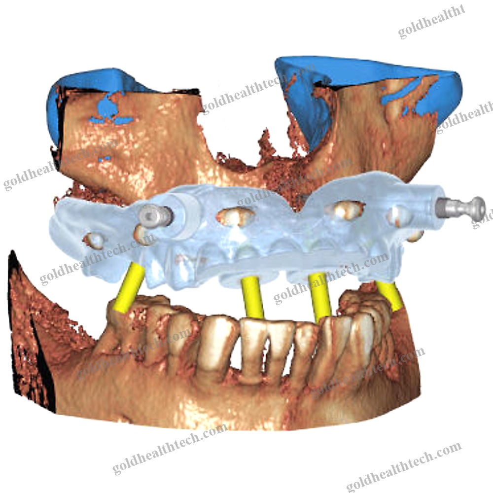 Dental Implantology Software