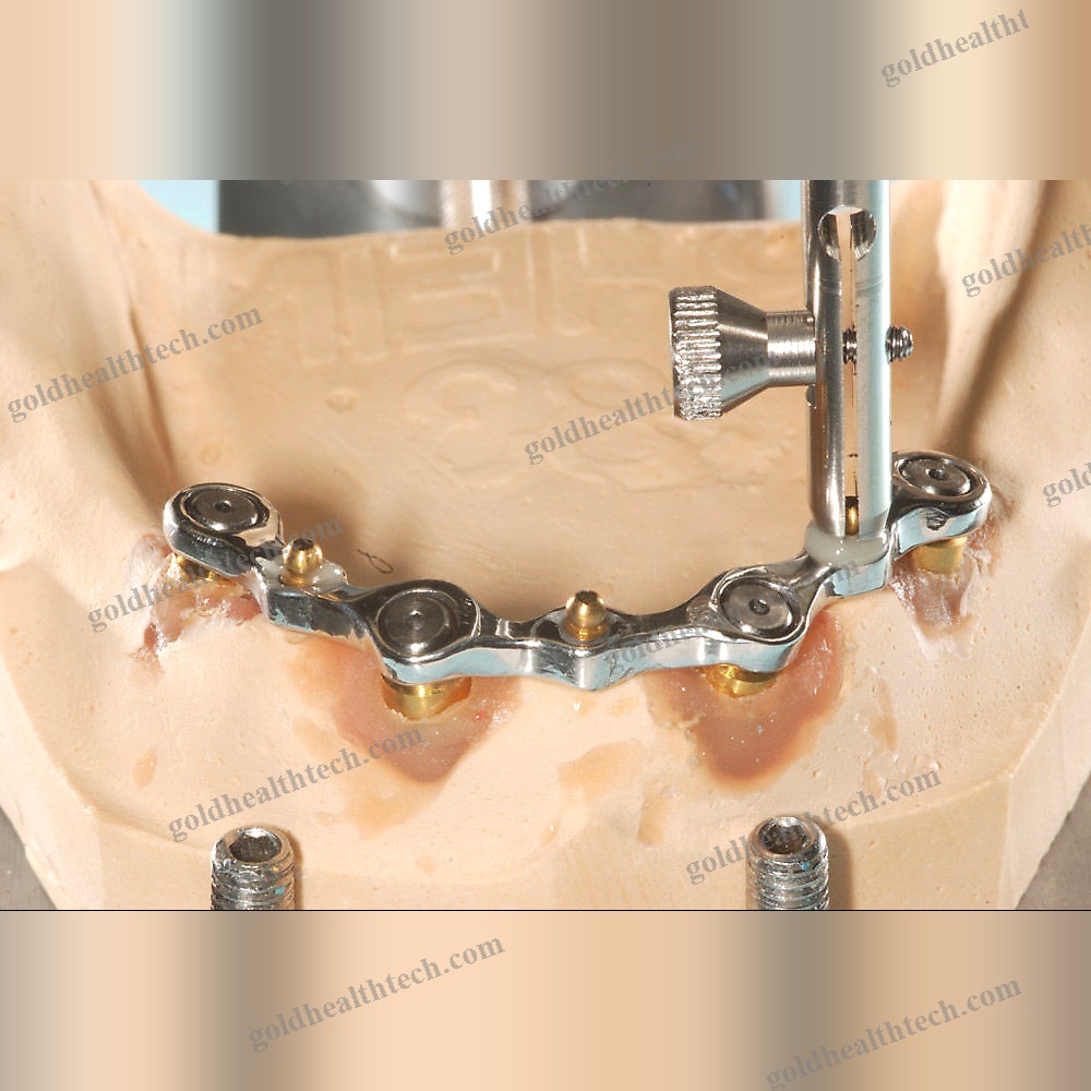 Titanium Dental Implant Sleeve