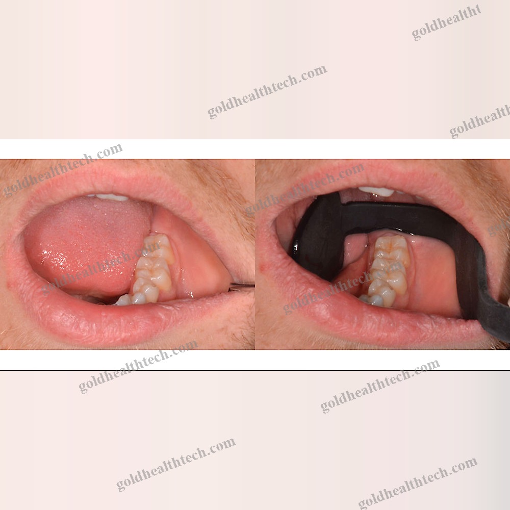 Dental Retractor