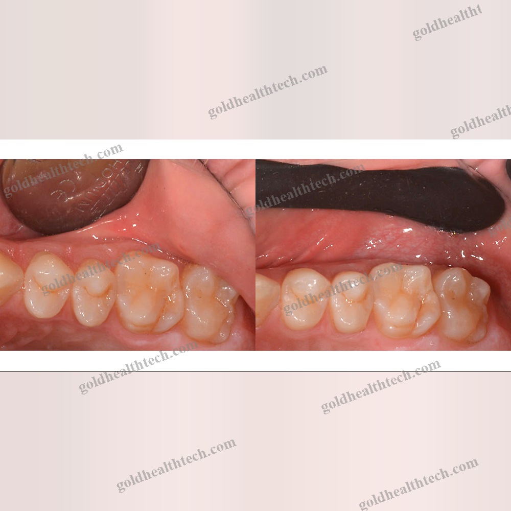 Dental Retractor