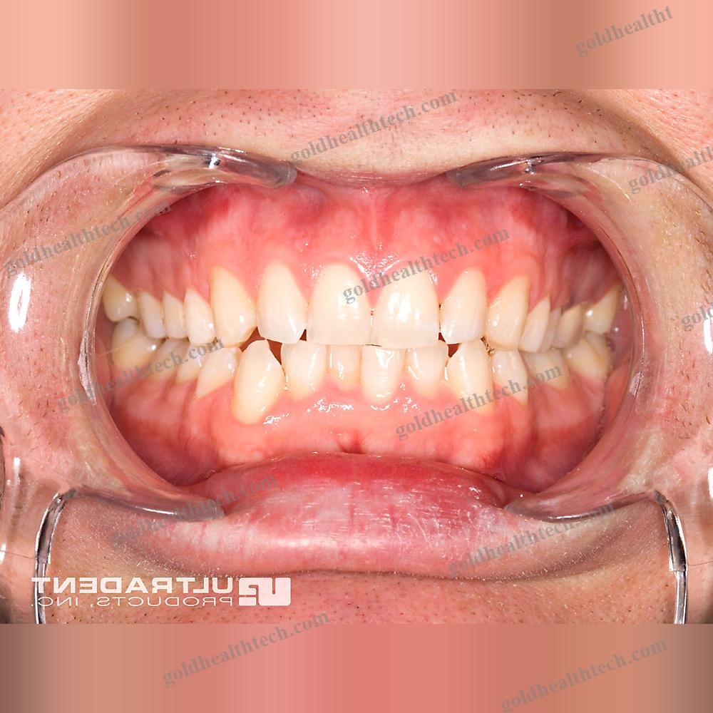 Cheek Retractor