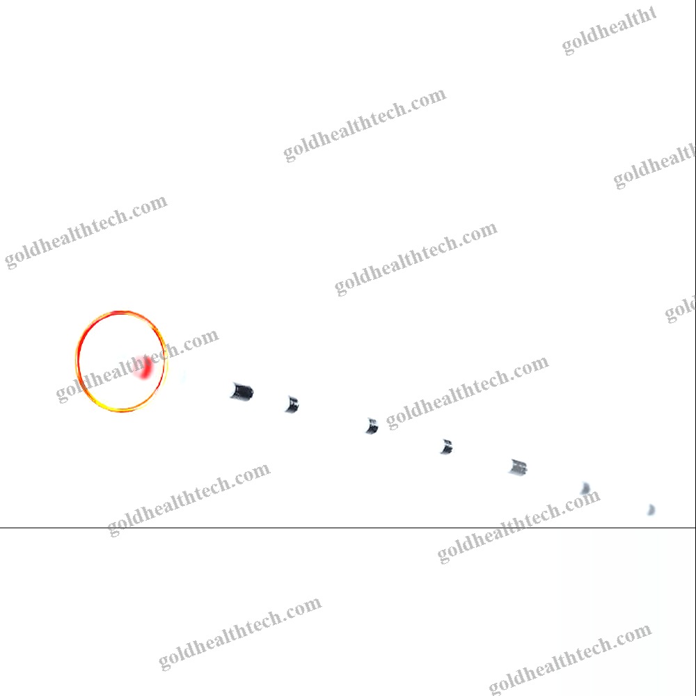 Phlebology Laser