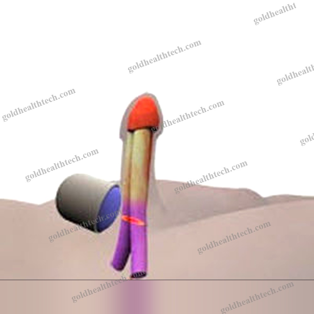 Erectile Dysfunction Eswt Unit