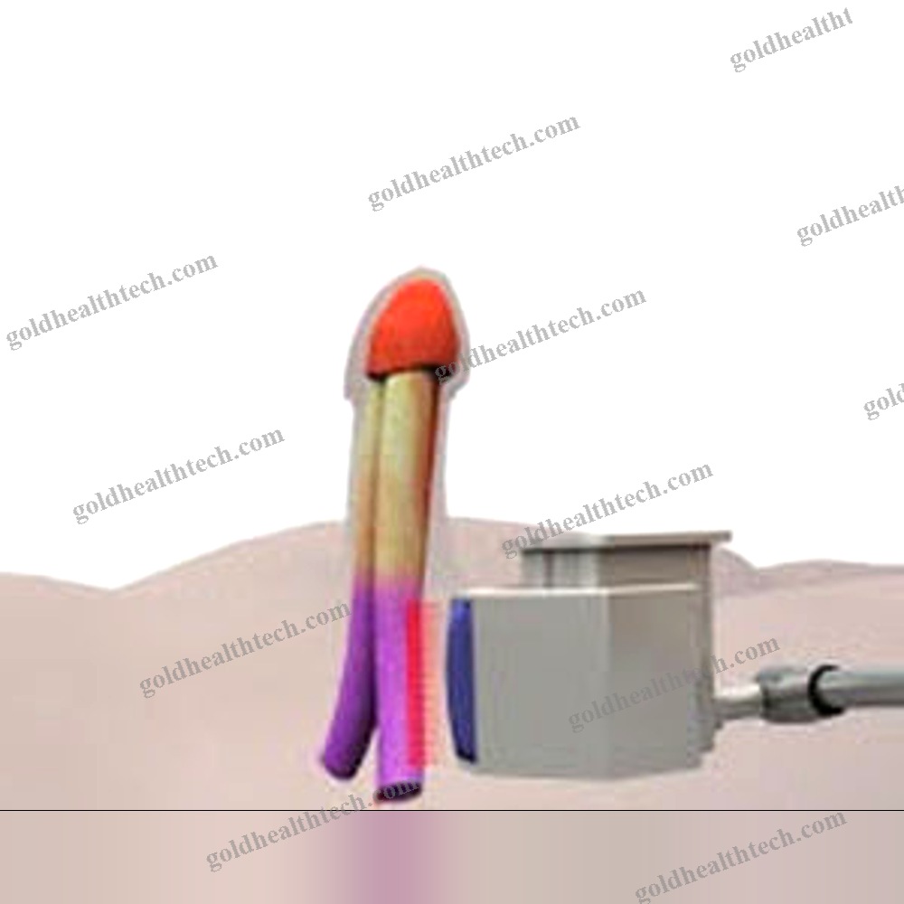 Erectile Dysfunction Eswt Unit