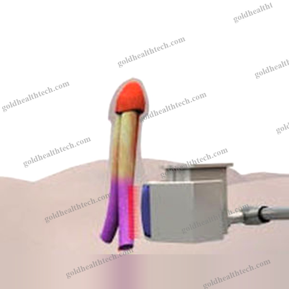 Erectile Dysfunction Eswt Unit