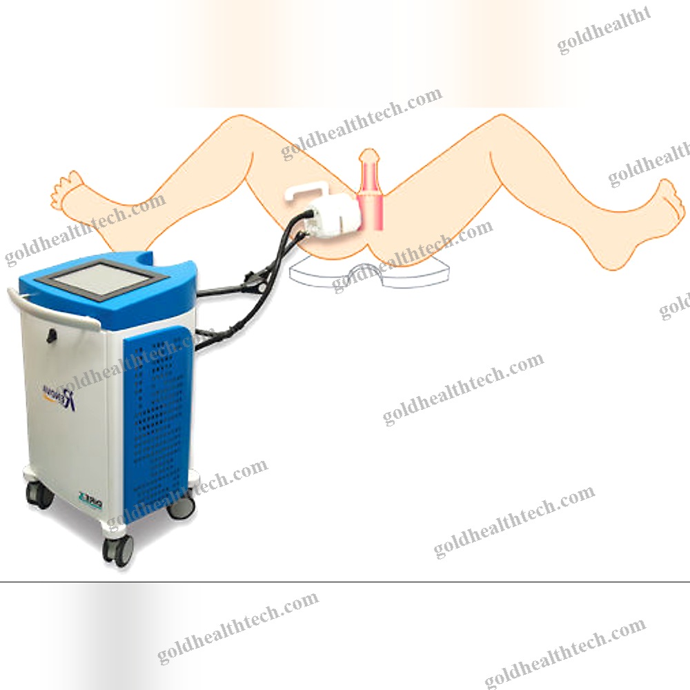 Erectile Dysfunction Eswt Unit