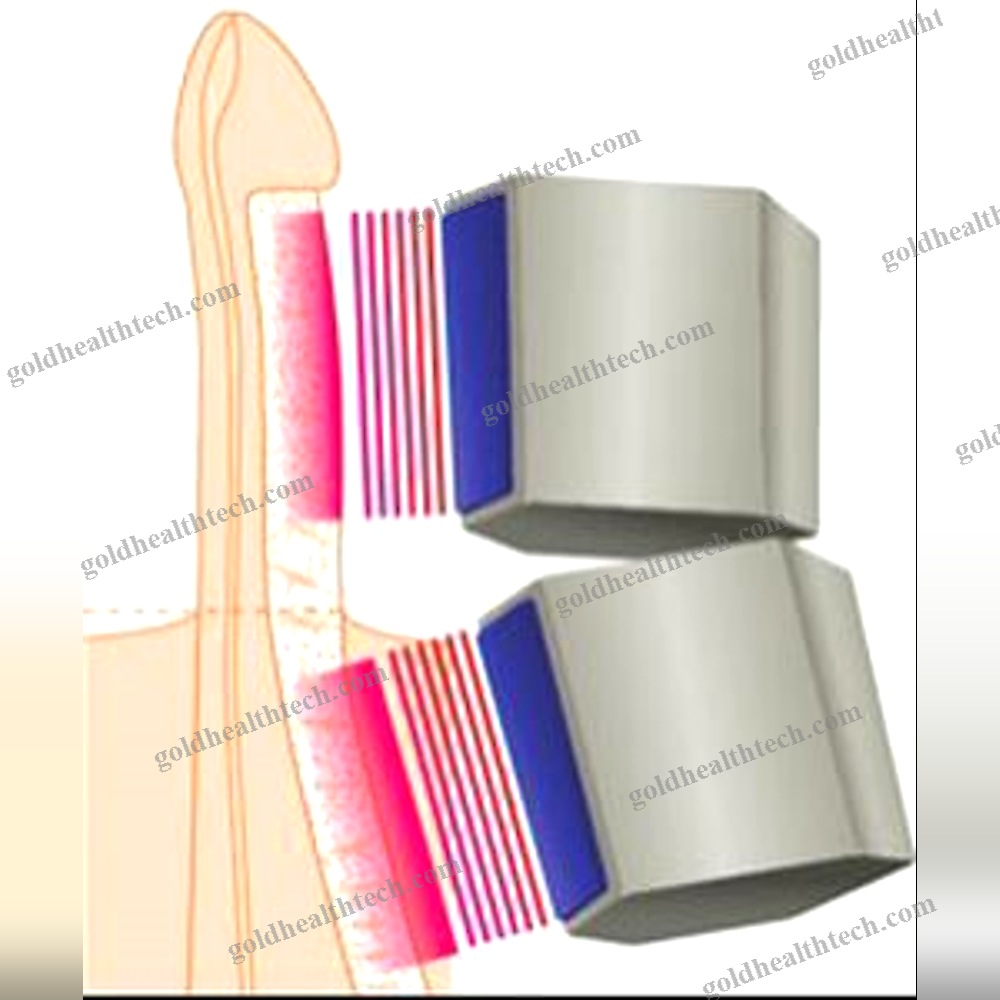 Erectile Dysfunction Eswt Unit