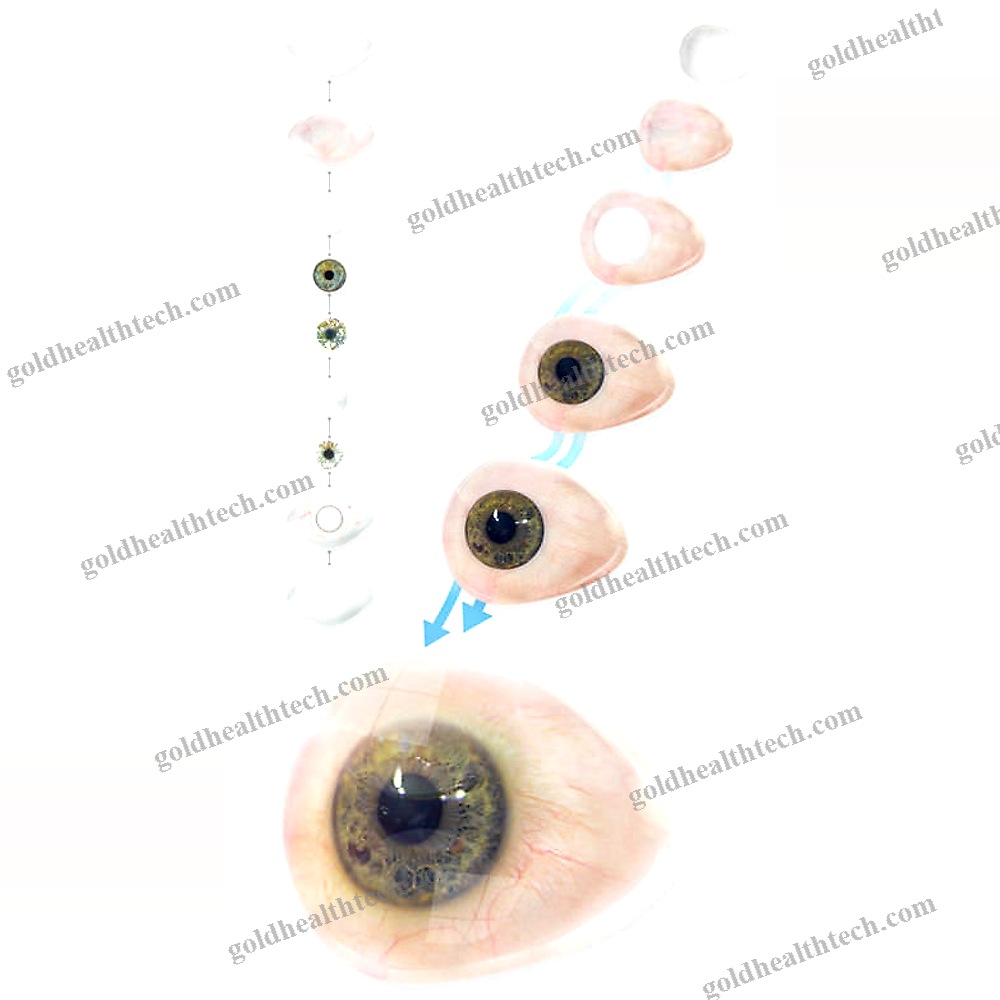 Eye Cosmetic Prosthesis