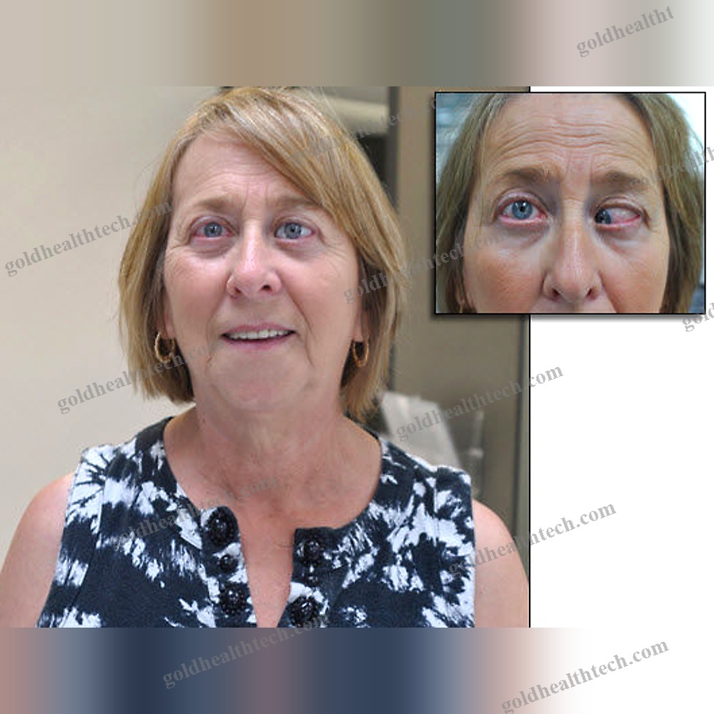 Eye Cosmetic Prosthesis