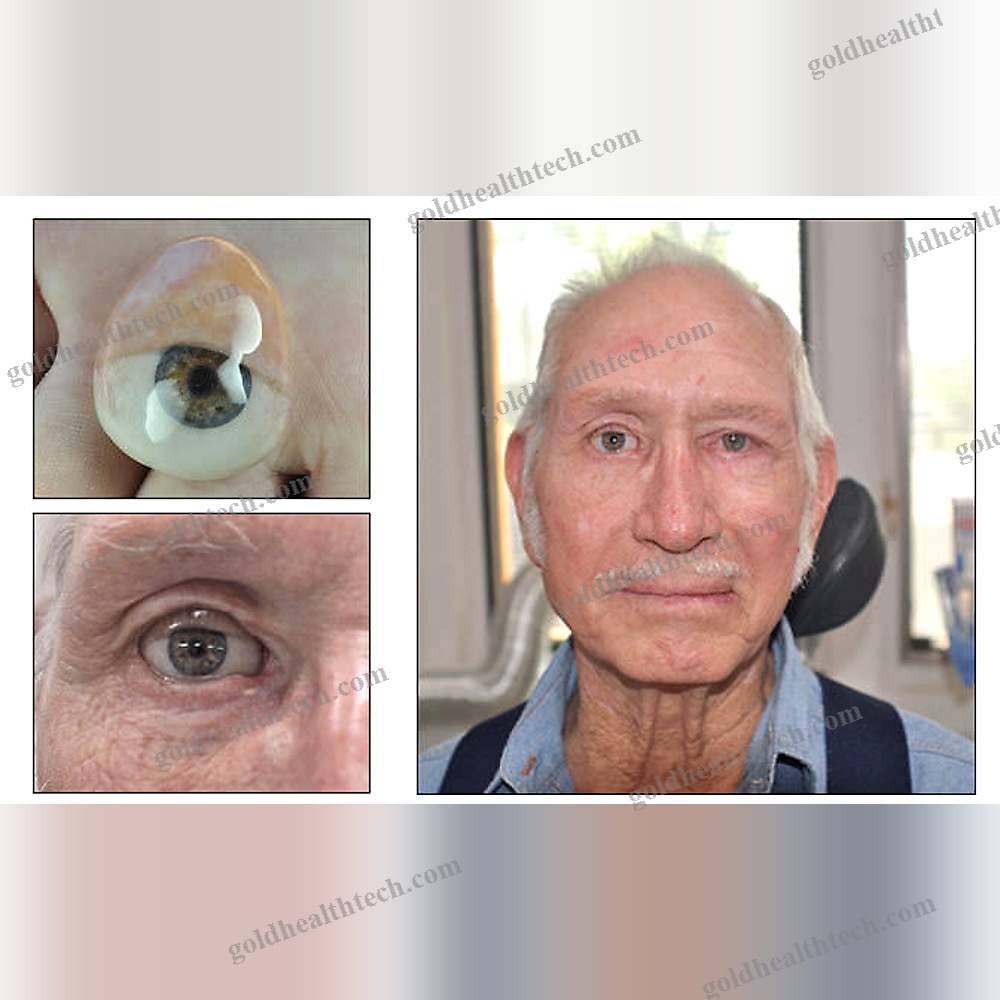 Eye Cosmetic Prosthesis