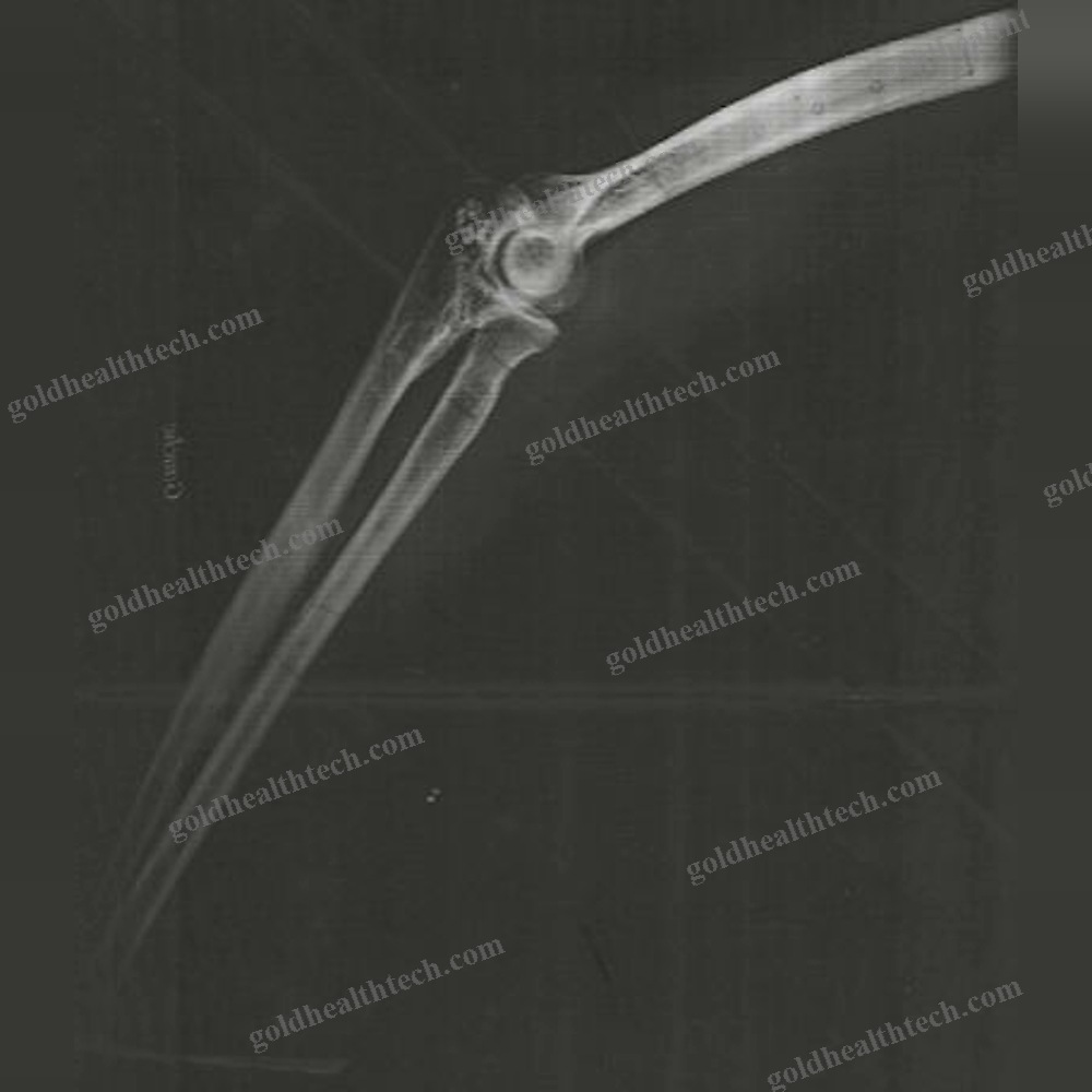 Elbow Arthrodesis Plate