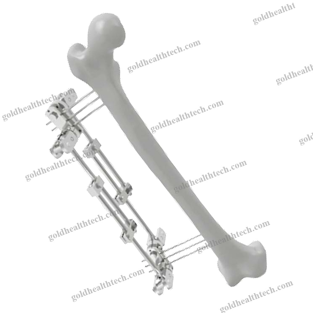 Femur External Fixation System