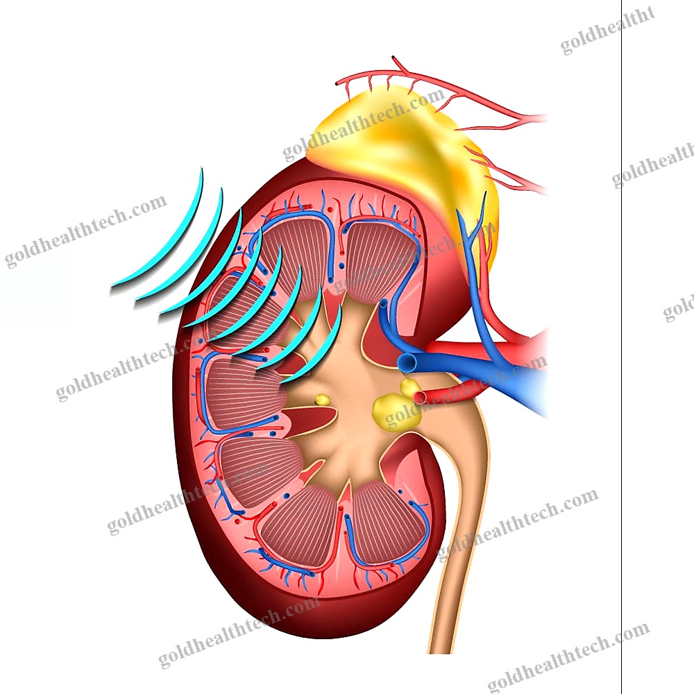 Extracorporeal Lithotripter