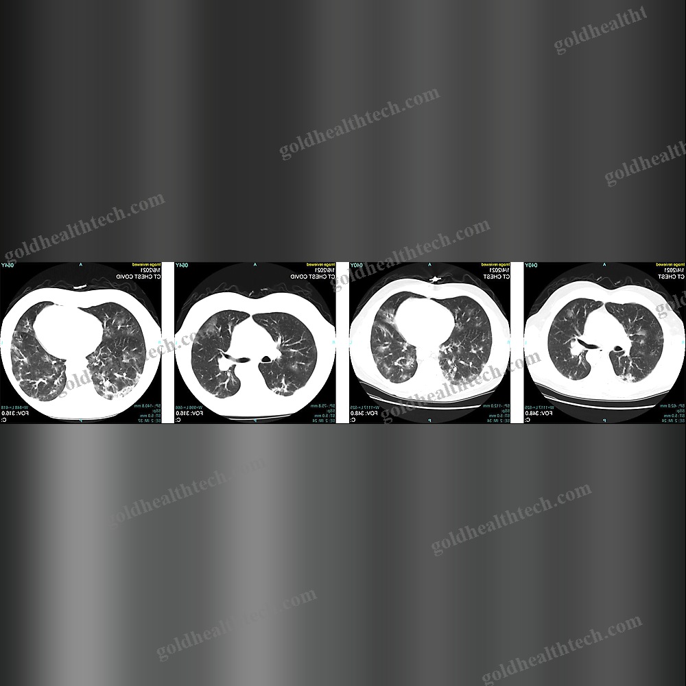 Covid-19 Diagnosis Software