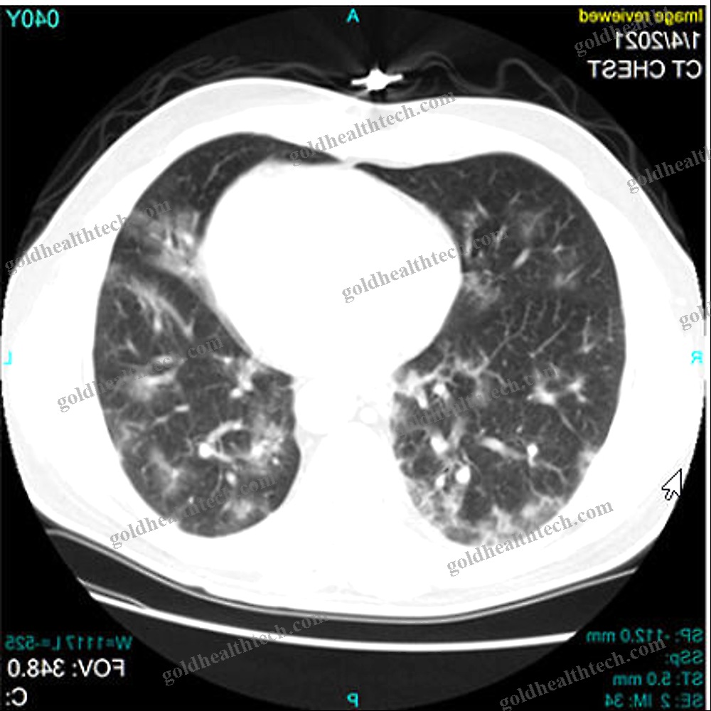 Covid-19 Diagnosis Software