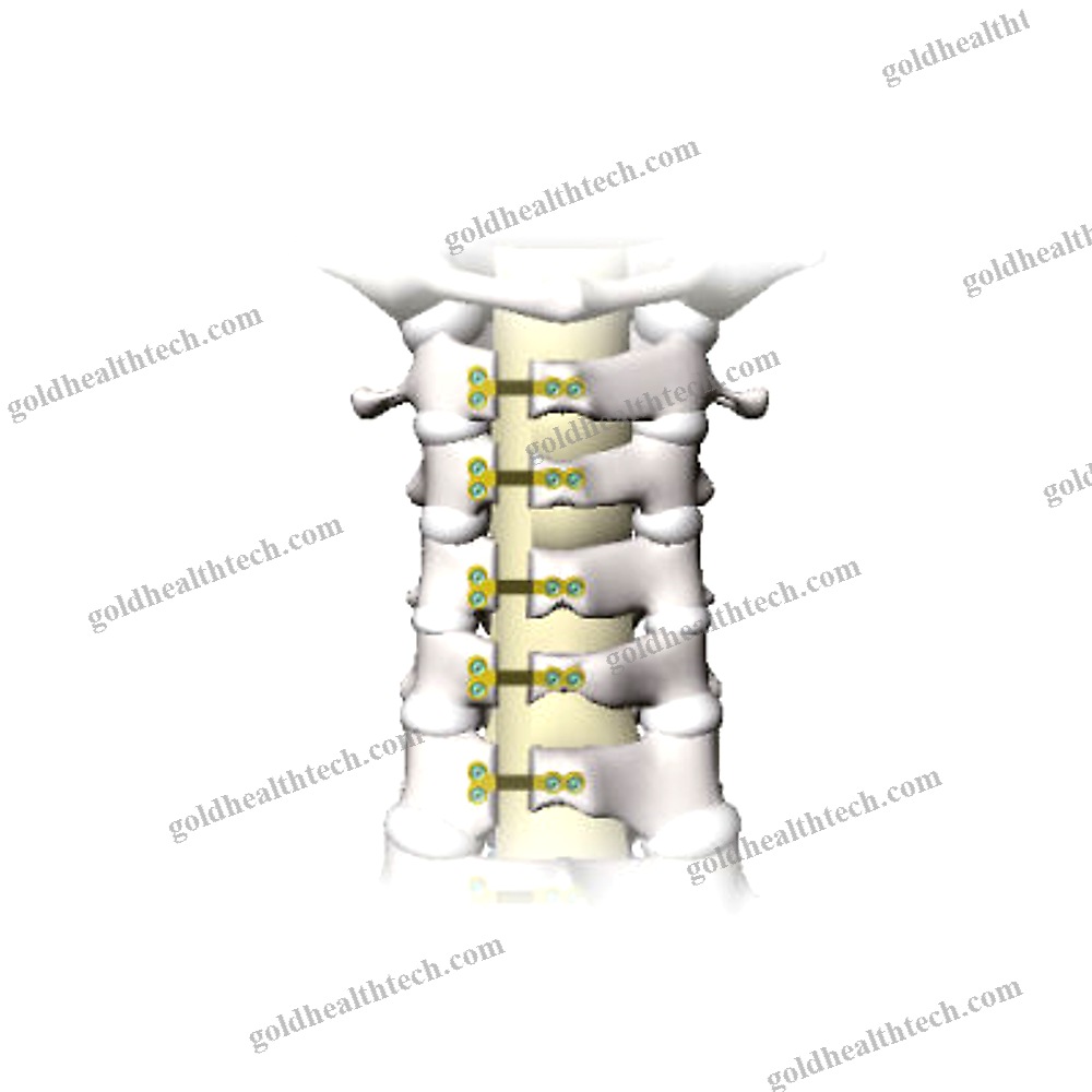 Cervical Laminoplasty Plate