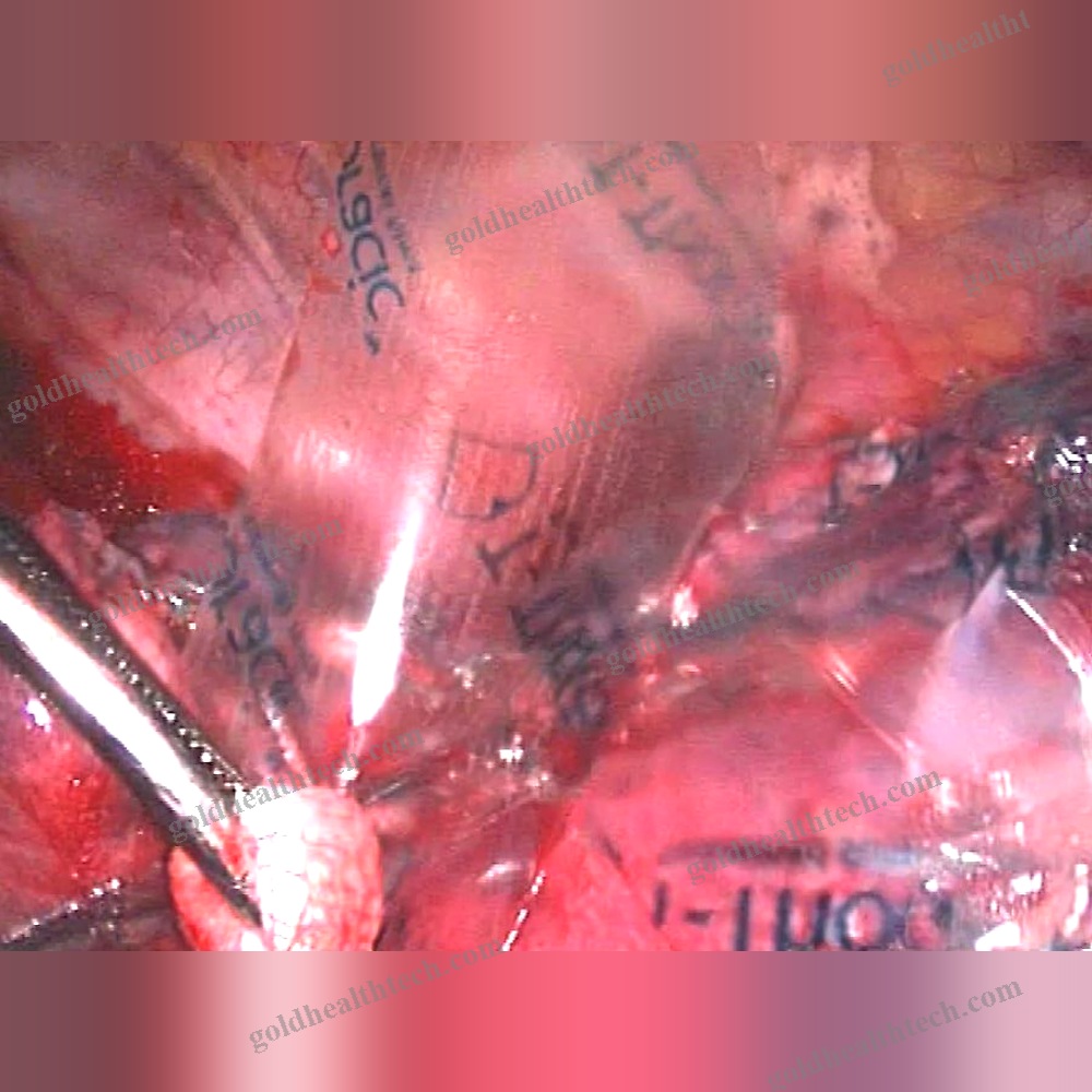 Thoracic Tissue Matrix
