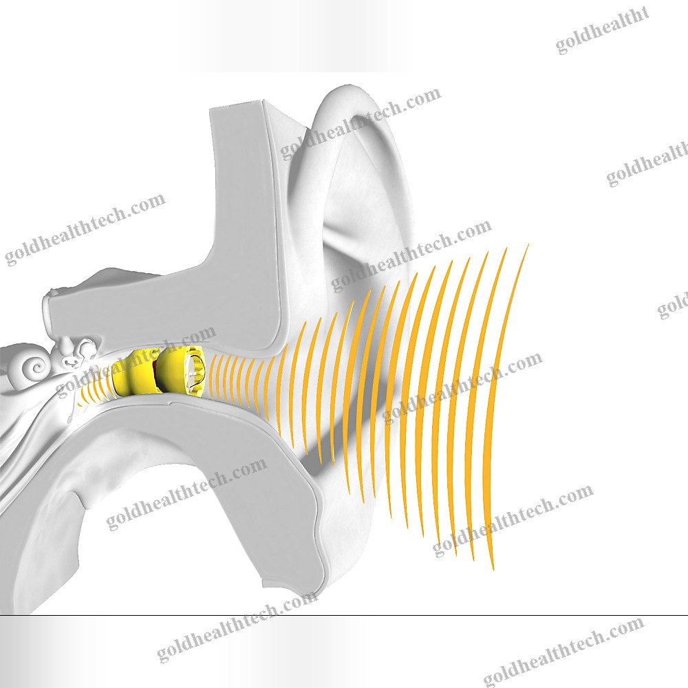 Iic Hearing Aid