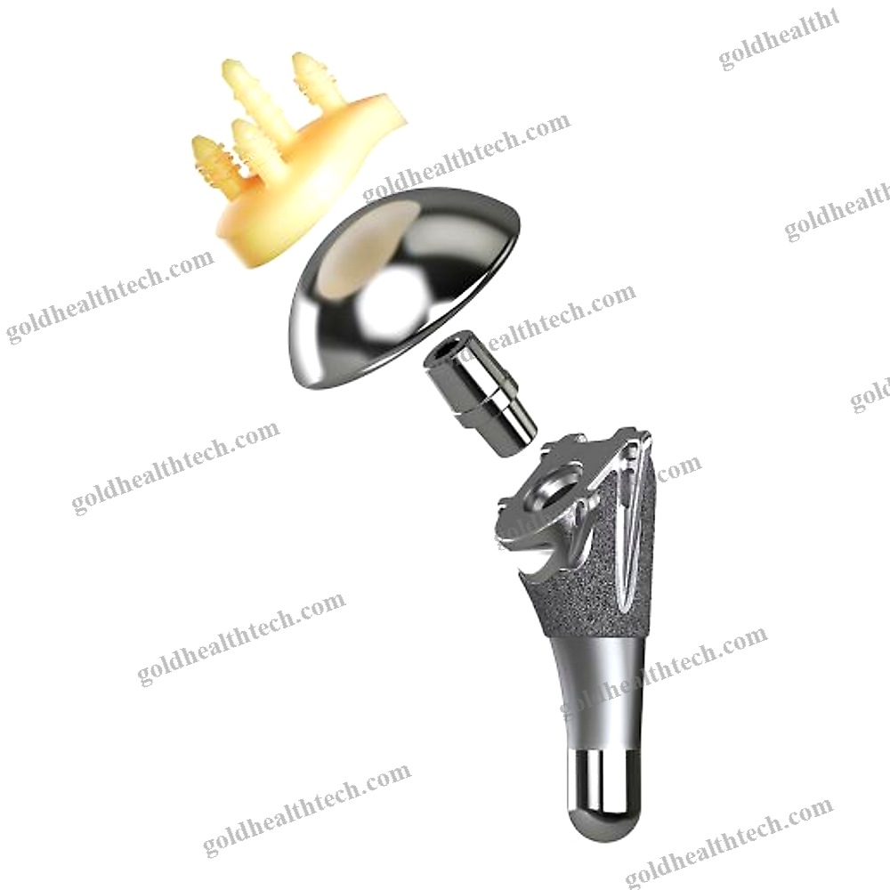Cementless Shoulder Prosthesis