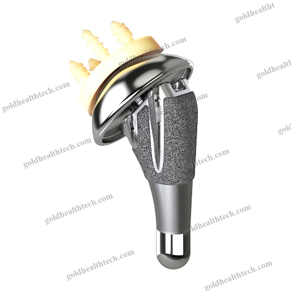 Cementless Shoulder Prosthesis