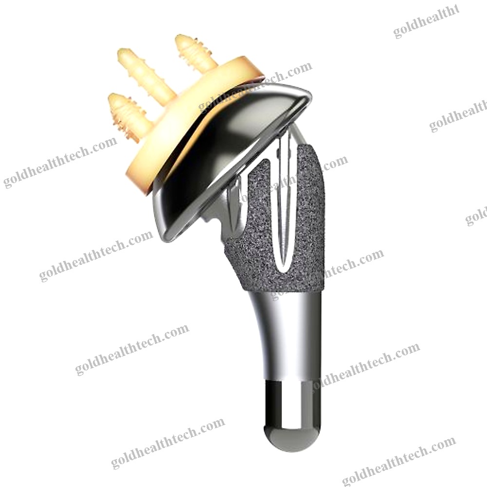 Cementless Shoulder Prosthesis
