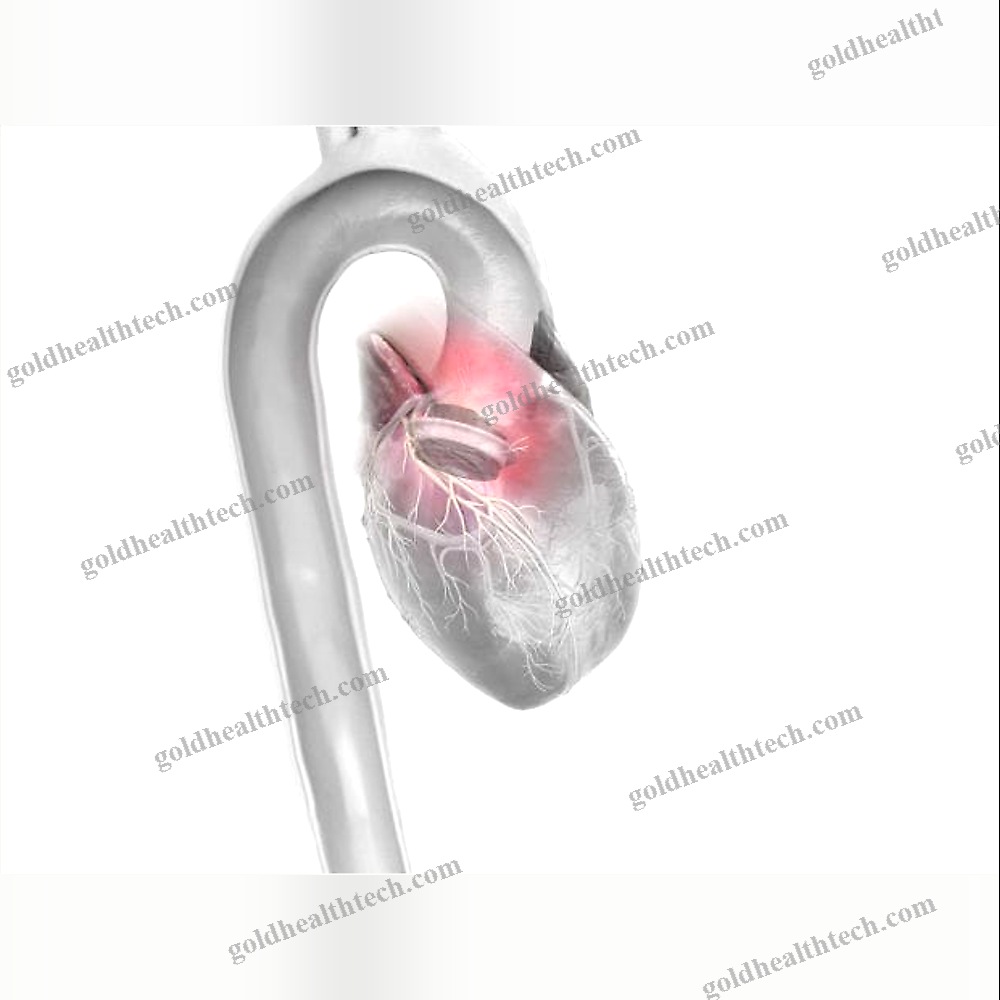 Aortic Valve Prosthesis