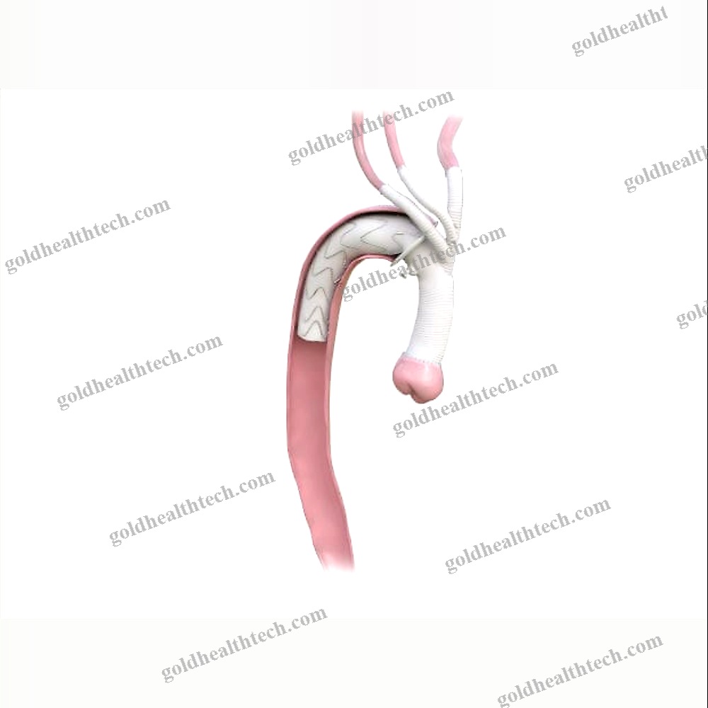 Descending Thoracic Aorta Stent Graft