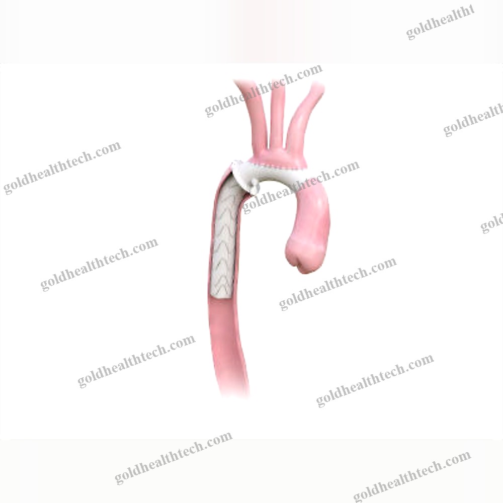 Descending Thoracic Aorta Stent Graft