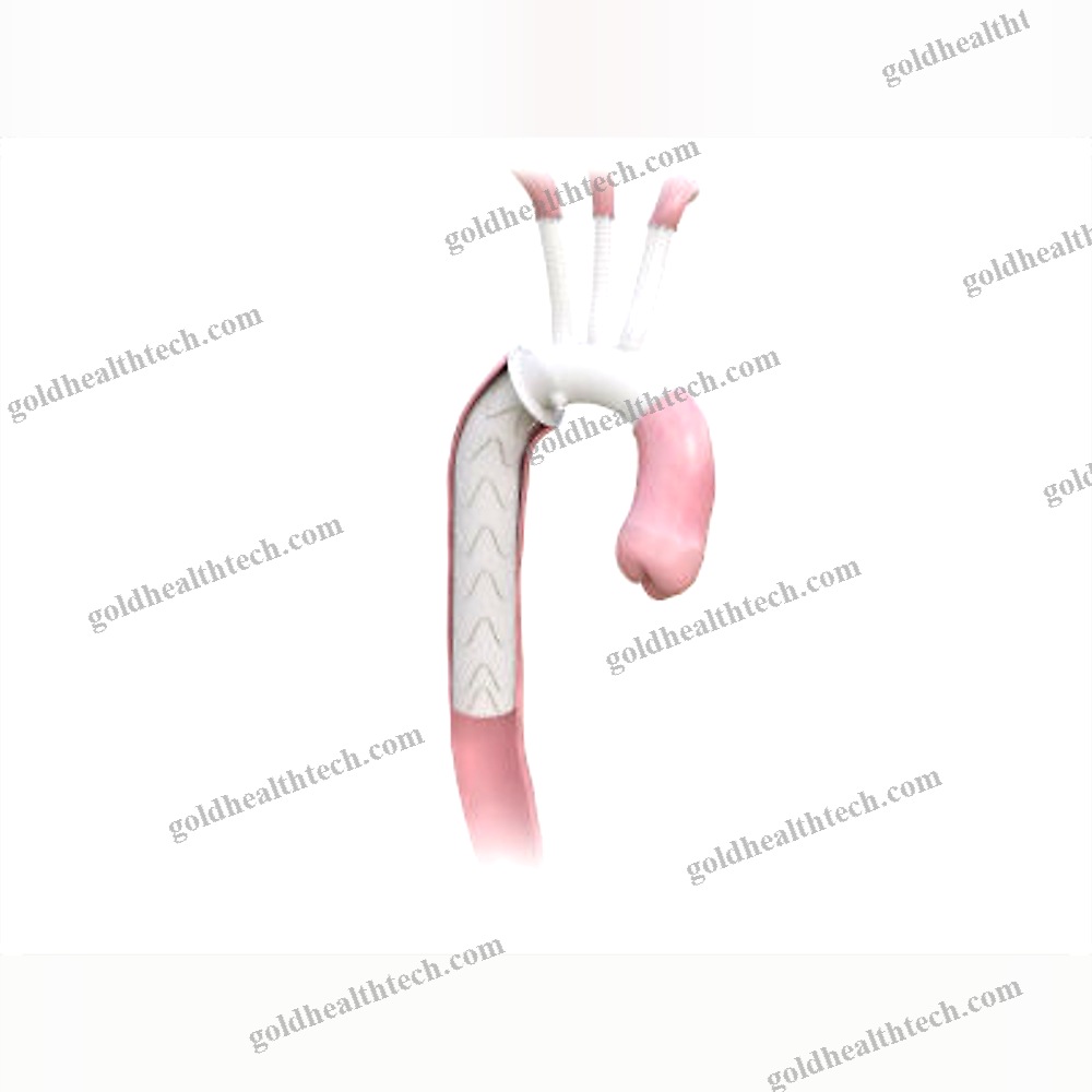 Descending Thoracic Aorta Stent Graft
