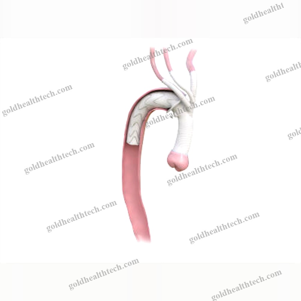 Descending Thoracic Aorta Stent Graft