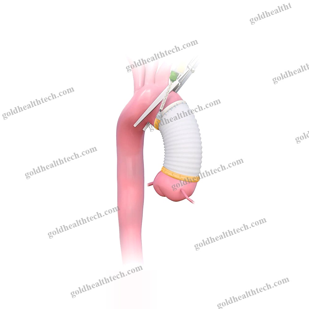 Vascular Surgery Tissue Adhesive