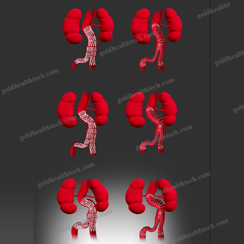 Abdominal Aorta Stent Graft