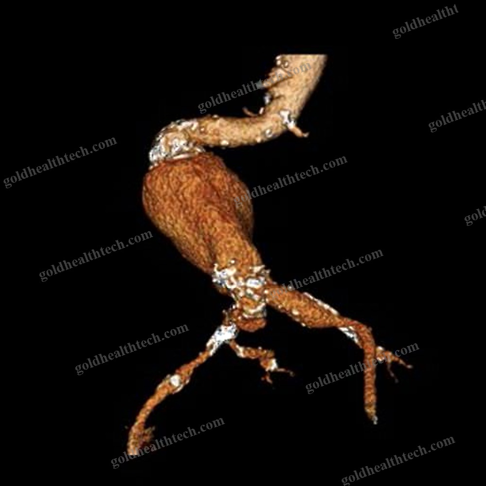 Abdominal Aorta Stent Graft